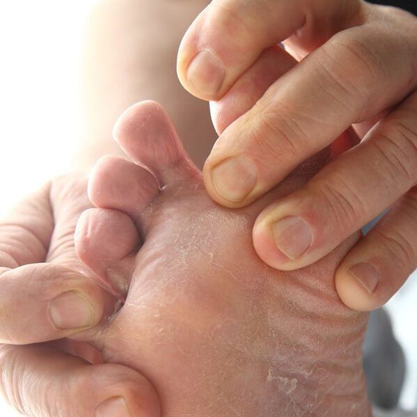Le champignon affecte la peau entre les orteils