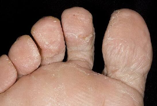 Manifestations d'une infection fongique sur les pieds