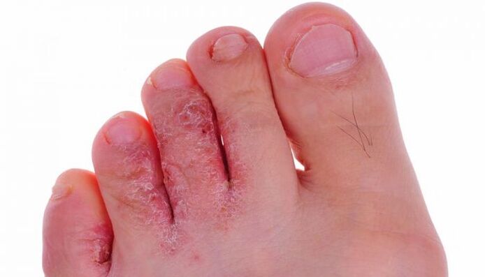 infection fongique de la peau des orteils