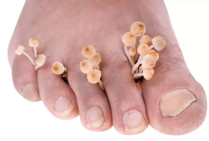 Le champignon des pieds