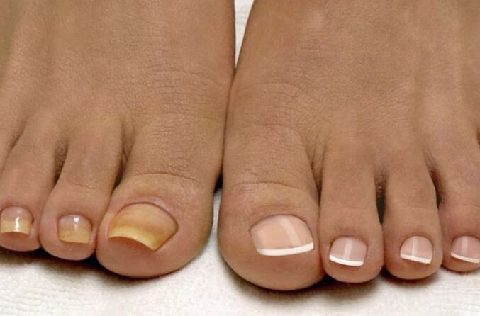 Le champignon sur les jambes