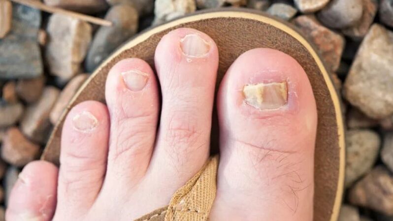Mycose des ongles