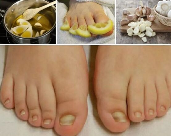Remèdes folkloriques pour les champignons à ongles