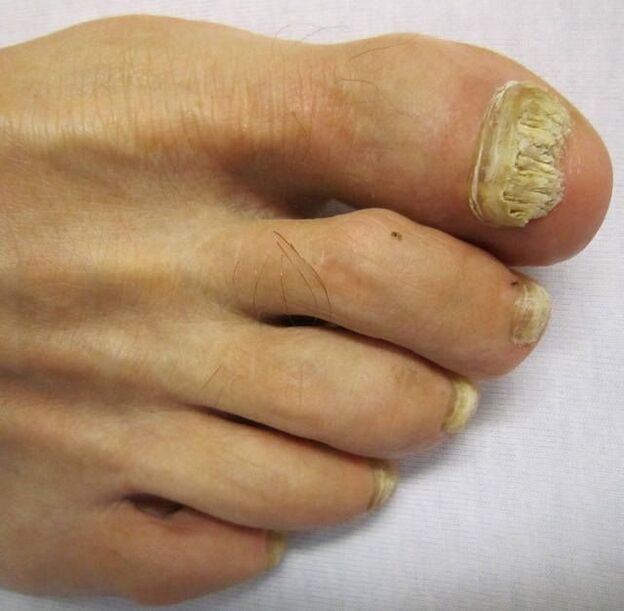 Endommager les plaques d'ongle