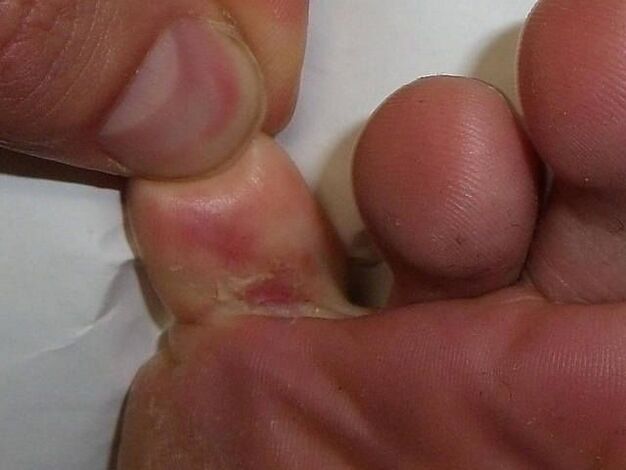L'effet du champignon sur la peau