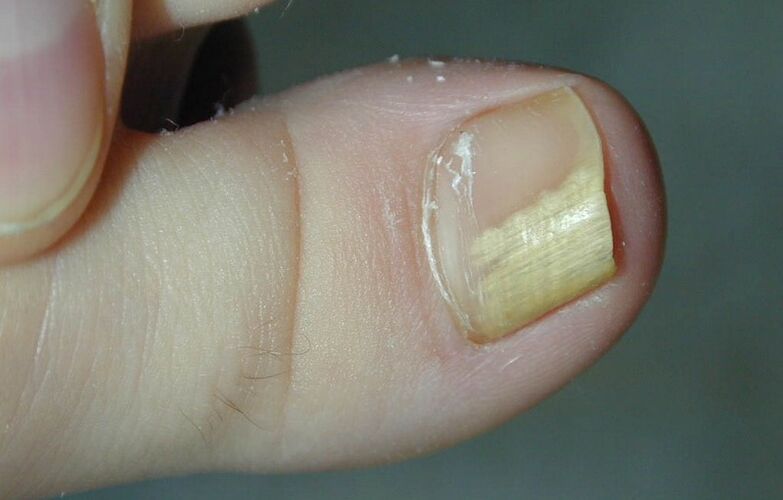 mycose des ongles des orteils