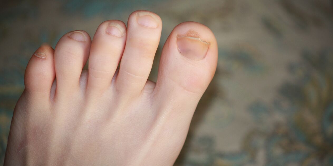 mycose des ongles des orteils