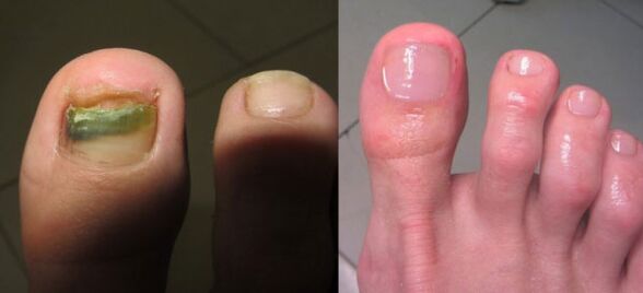 Traitement des champignons à ongles