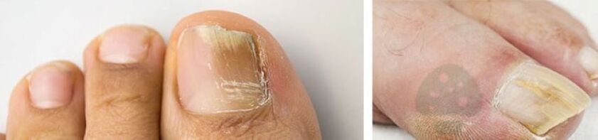 Le champignon des ongles du pouce sur la jambe