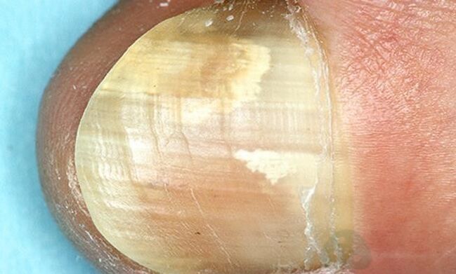 Traitement des champignons du bout des doigts avec des médicaments d'action interne