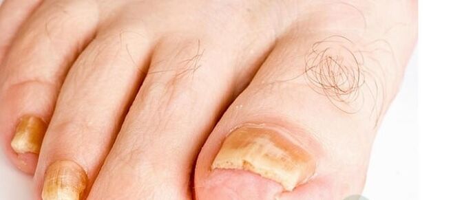 Variétés du champignon des ongles de doigt