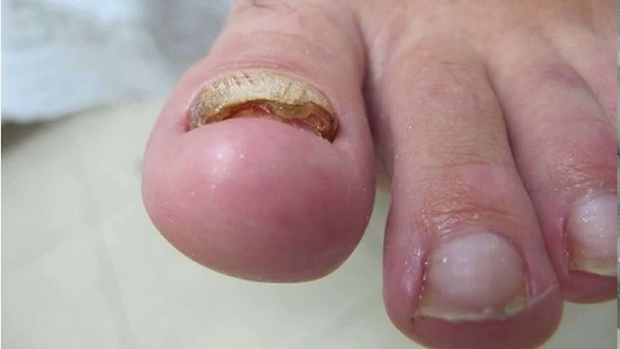Champignon hypertrophique - déformation des bords, perte de couleur et épaississement de la plaque à ongles