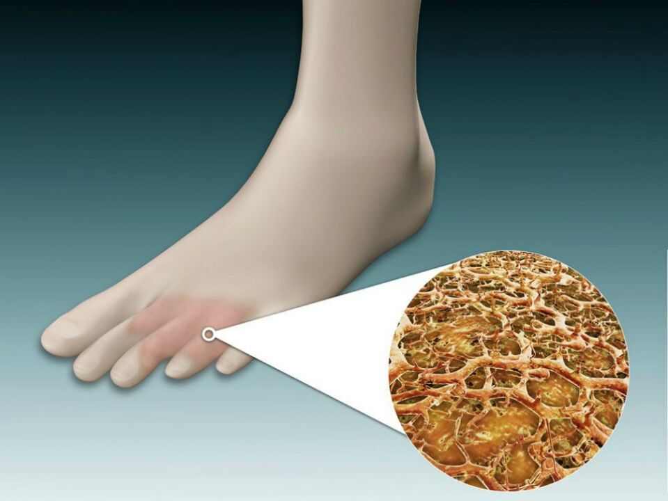Rougeur de la peau entre et près des orteils avec champignon intertrigineux
