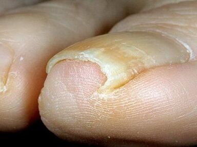 Apparition d’ongles infectés par des champignons