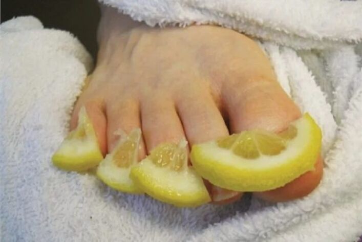 Compresses de gouttes de citron - un remède populaire contre la mycose des ongles des pieds